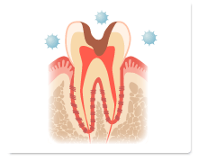 むし歯