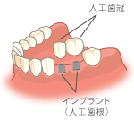 インプラント