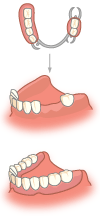 部分入れ歯
