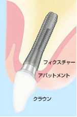 インプラントとは